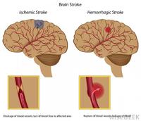 obat stroke kiri